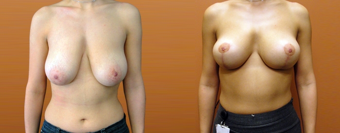 Breast Lift Without Implants Patient 4 — Front View