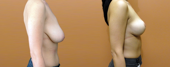 Breast Lift Without Implants Patient 4 — Side View