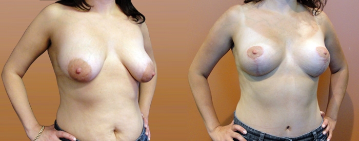 Breast Lift Without Implants Patient 5 — Angle View
