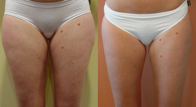 Liposuction Patient 2 — Front View