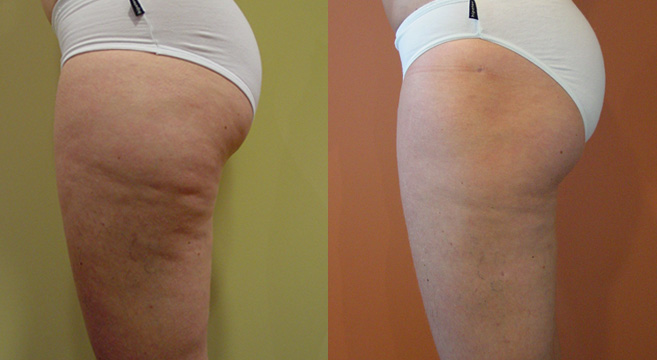 Liposuction Patient 2 — Side View