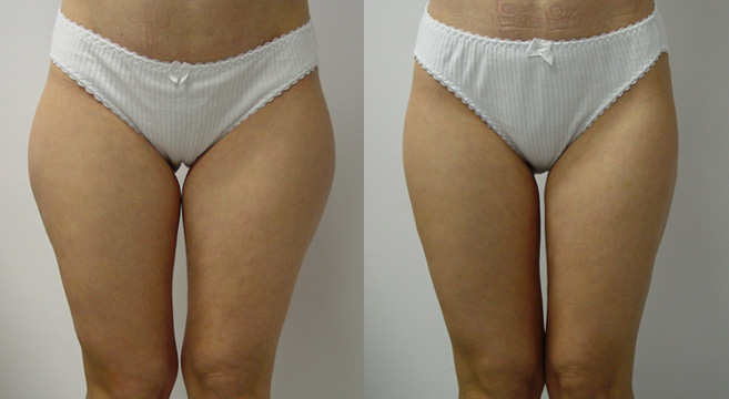 Liposuction Patient 3 — Front View