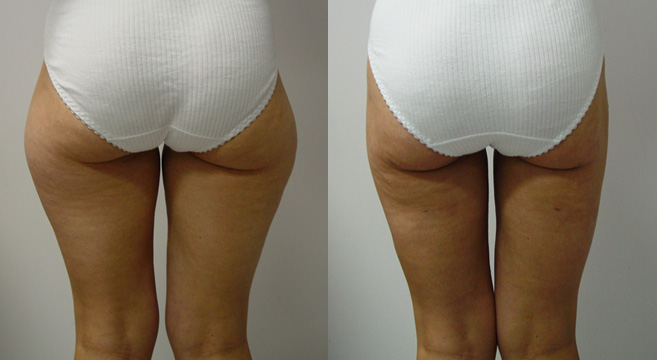 Liposuction Patient 3 — Back View