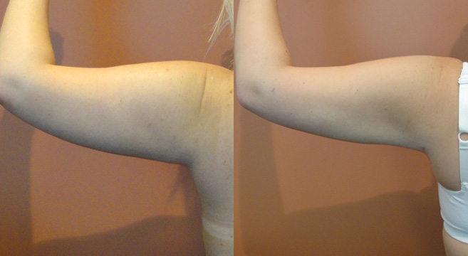Liposuction Patient 4 — Back Arm View
