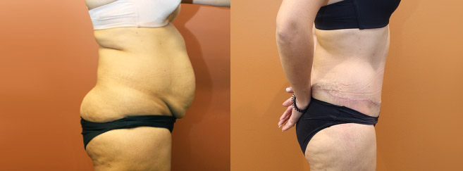 Tummy Tuck — Side View