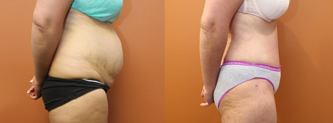 Tummy Tuck — Side View