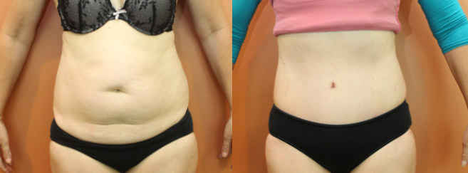 Tummy Tuck — Front View