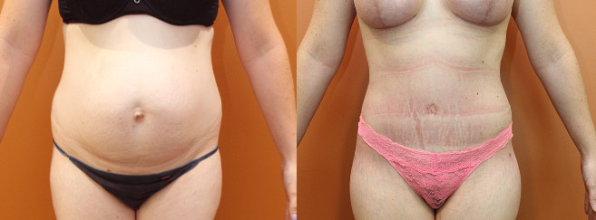 Tummy Tuck — Front View