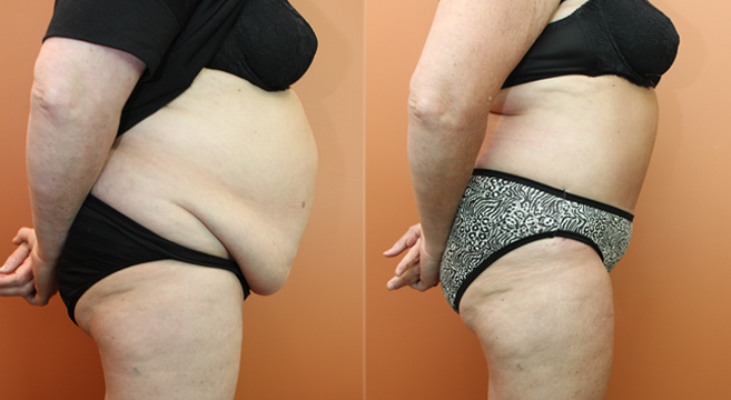 Tummy Tuck Patient — Side View