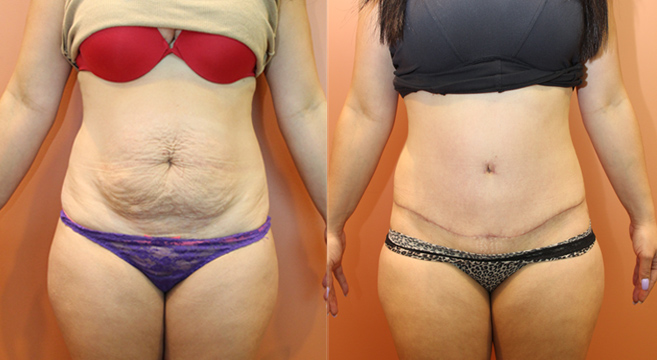 Tummy Tuck Patient — Front View
