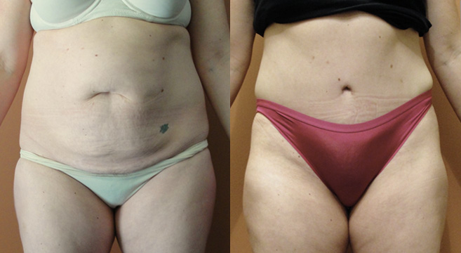 Tummy Tuck Patient 2 — Front View