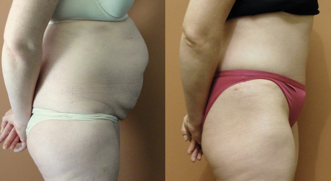Tummy Tuck Patient 2 — Side View