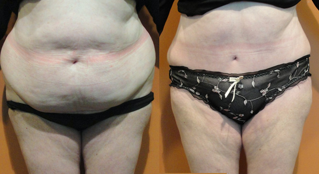 Tummy Tuck Patient 3 — Front View