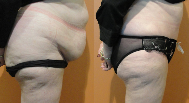 Tummy Tuck Patient 3 — Side View