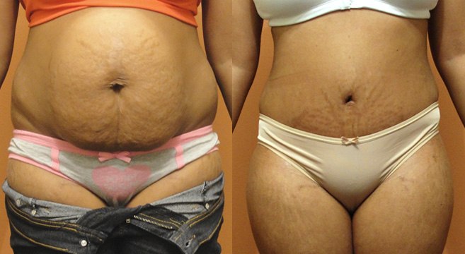 Tummy Tuck Patient 4 — Front View