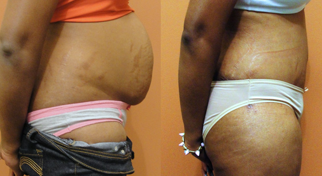 Tummy Tuck Patient 4 — Side View