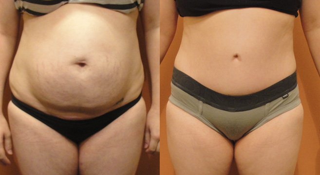 Tummy Tuck Patient 5 — Front View