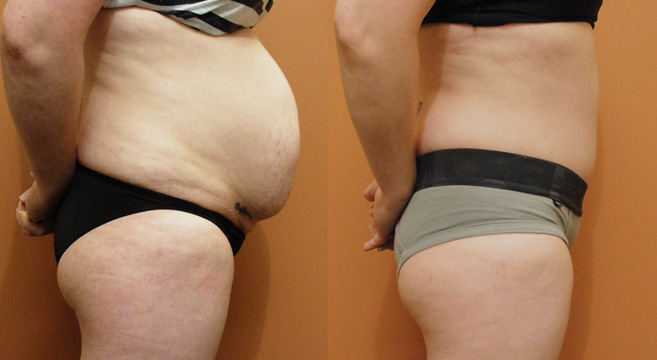 Tummy Tuck Patient 5 — Side View