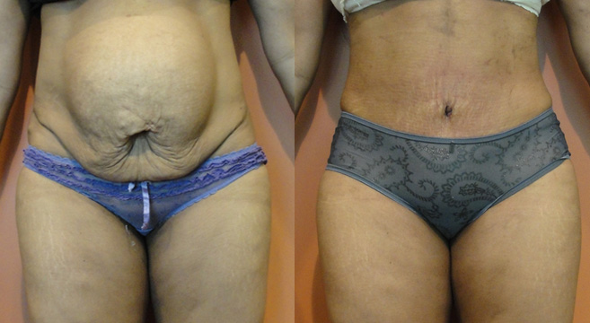 Tummy Tuck Patient 6 — Front View