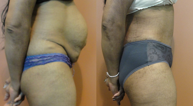 Tummy Tuck Patient 6 — Side View