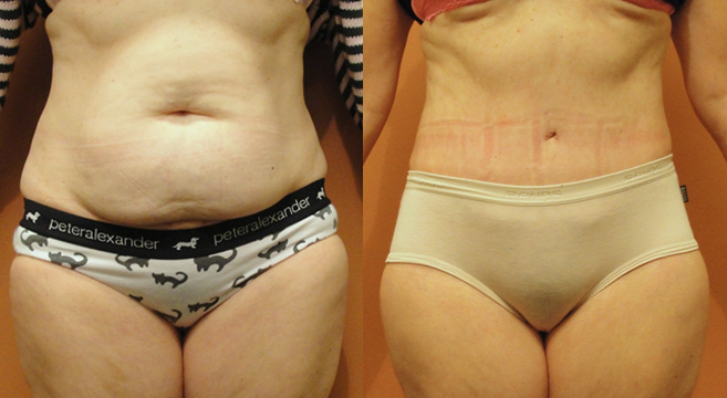 Tummy Tuck Patient 7 — Front View