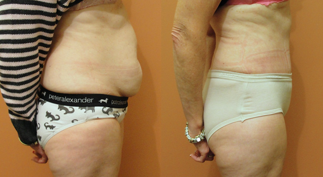 Tummy Tuck Patient 7 — Side View