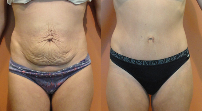 Tummy Tuck Patient 9 — Front View