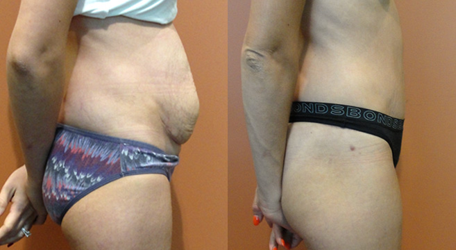 Tummy Tuck Patient 9 — Side View