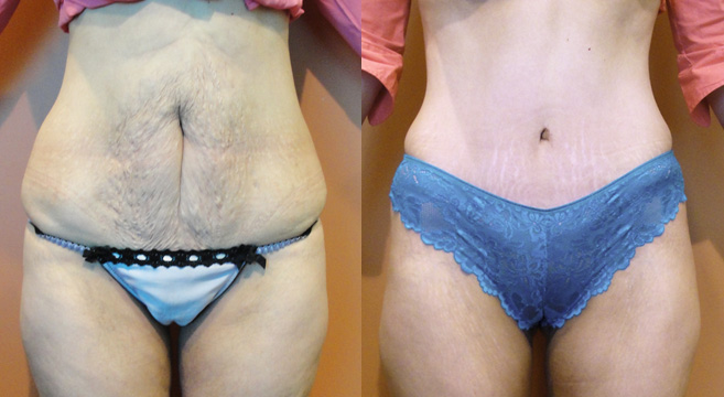 Tummy Tuck Patient 10 — Front View