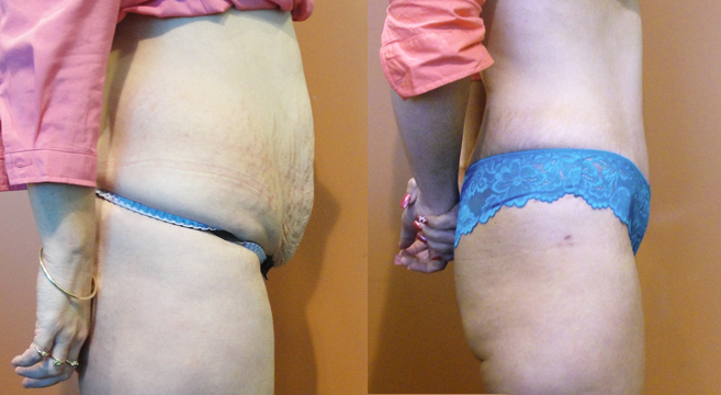 Tummy Tuck Patient 10 — Side View