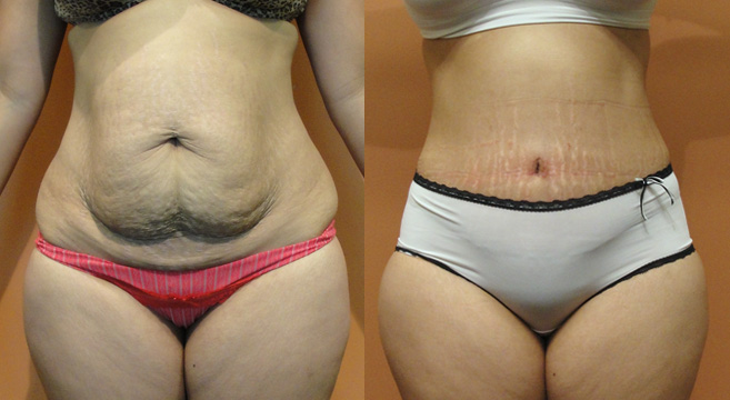 Tummy Tuck Patient 11 — Front View