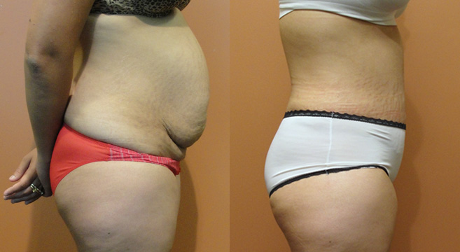 Tummy Tuck Patient 11 — Side View