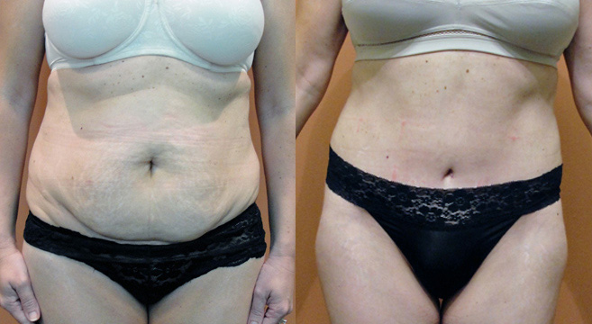 Tummy Tuck Patient 15 — Front View