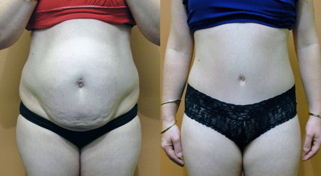 Tummy Tuck Patient 16 — Front View