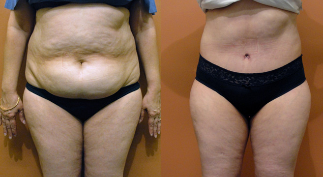 Tummy Tuck Patient 17 — Front View