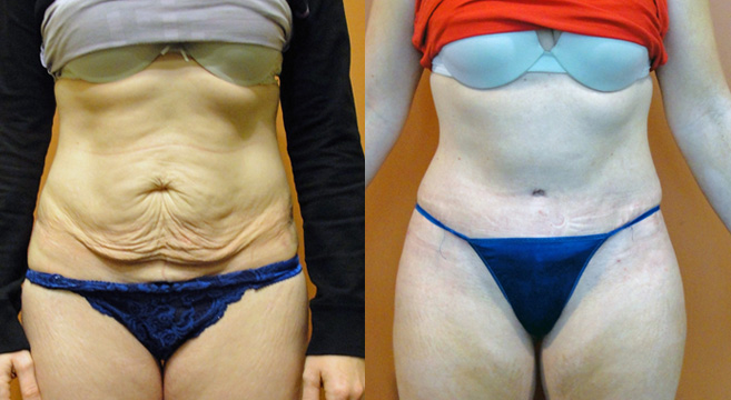 Tummy Tuck Patient 20 — Front View