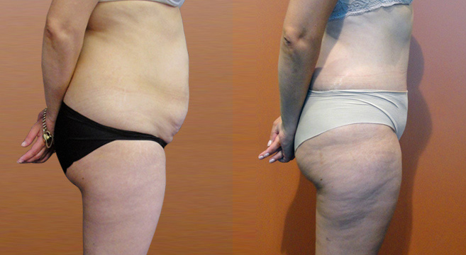 Tummy Tuck Patient 21 — Side View