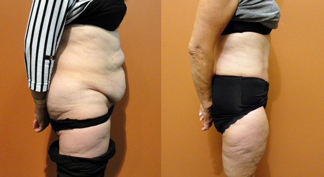 Tummy Tuck Patient 24 — Side View