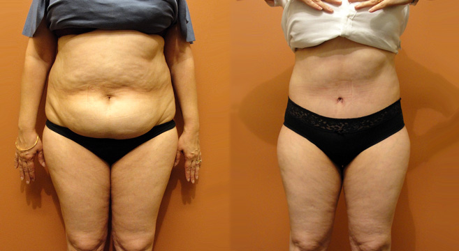 Tummy Tuck Patient 27 — Front View