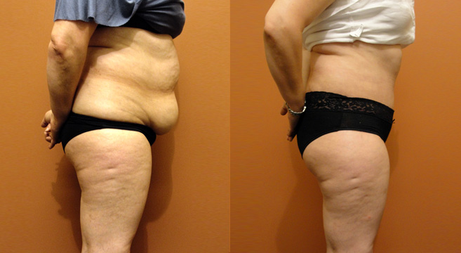 Tummy Tuck Patient 27 — Side View
