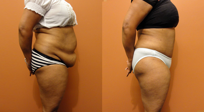 Tummy Tuck Patient 28 — Side View