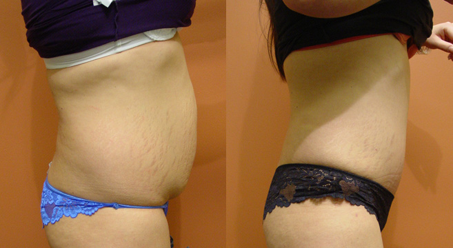 Tummy Tuck Patient 30 — Side View