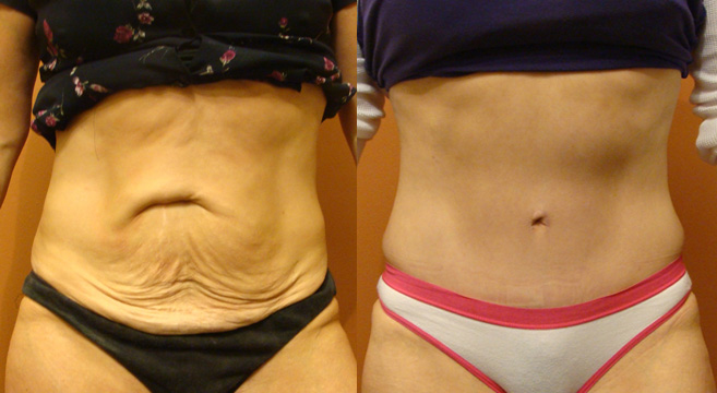 Tummy Tuck Patient 31 — Front View
