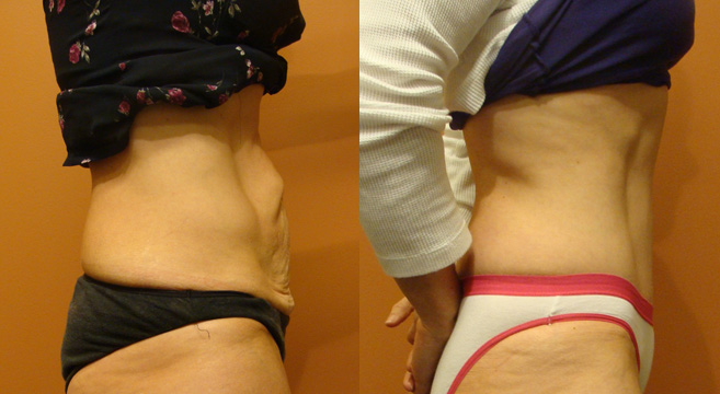Tummy Tuck Patient 31 — Side View