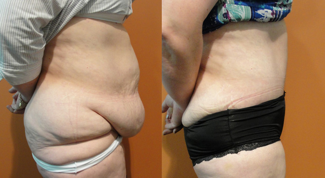 Tummy Tuck Patient 33 — Side View