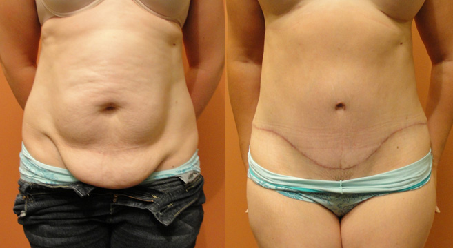 Tummy Tuck Patient 34 — Front View