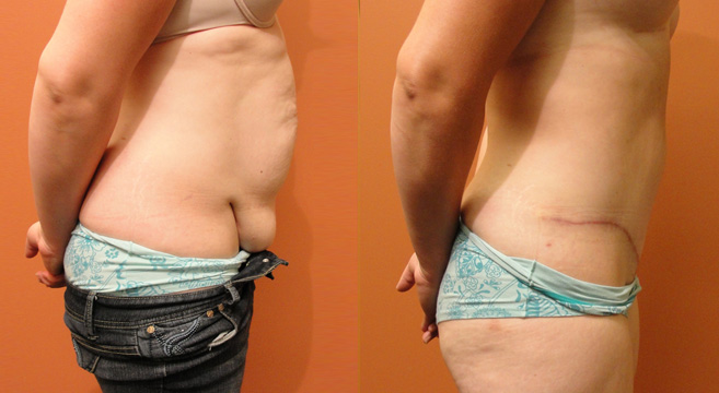 Tummy Tuck Patient 34 — Side View