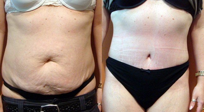 Tummy Tuck Patient 35 — Front View