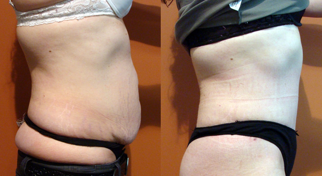 Tummy Tuck Patient 35 — Side View