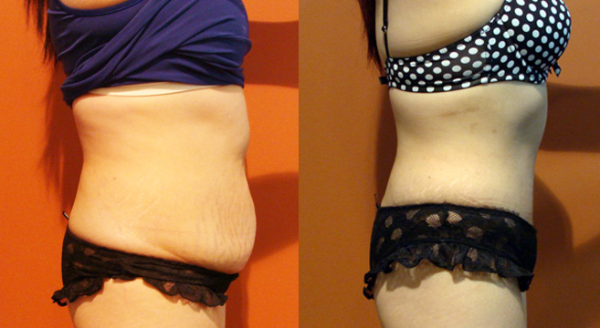 Tummy Tuck Patient 37 — Side View